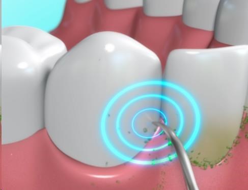 DentaPic Sonic - zářivě bílé zuby jako od profesionálů1 